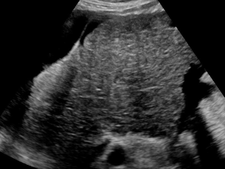 Ultrassonografia do abdome total em figado com cirrose