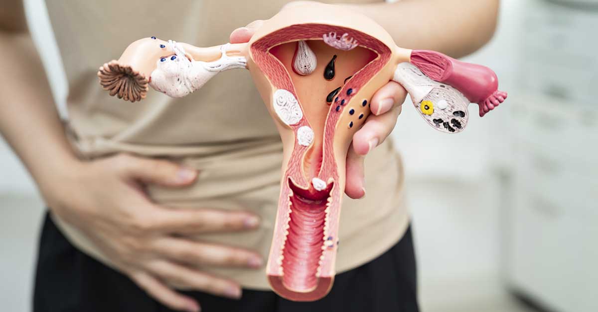 Endometriose profunda: o que é, sintomas graves e tratamentos especializados 2 Endometriose profunda: o que é, sintomas graves e tratamentos especializados