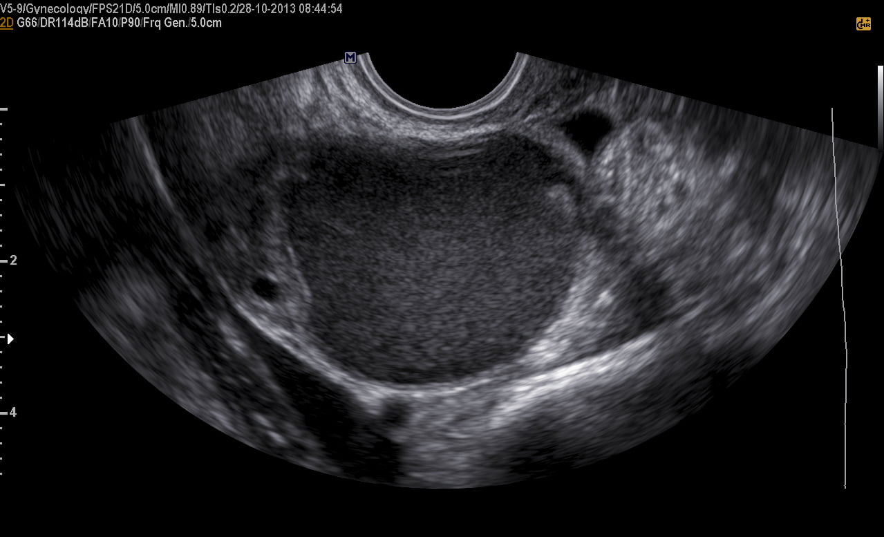 Ultrassom transvaginal com preparo intestinal - Dr. Fernando Guastella