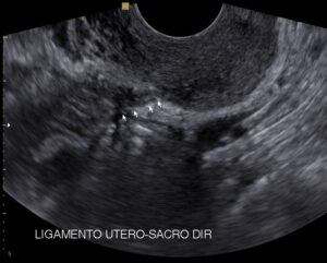 Ultrassom transvaginal com preparo intestinal