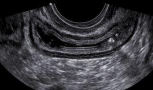 ultrassom transvaginal com preparo intestinal