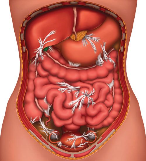 Endometriose no intestino