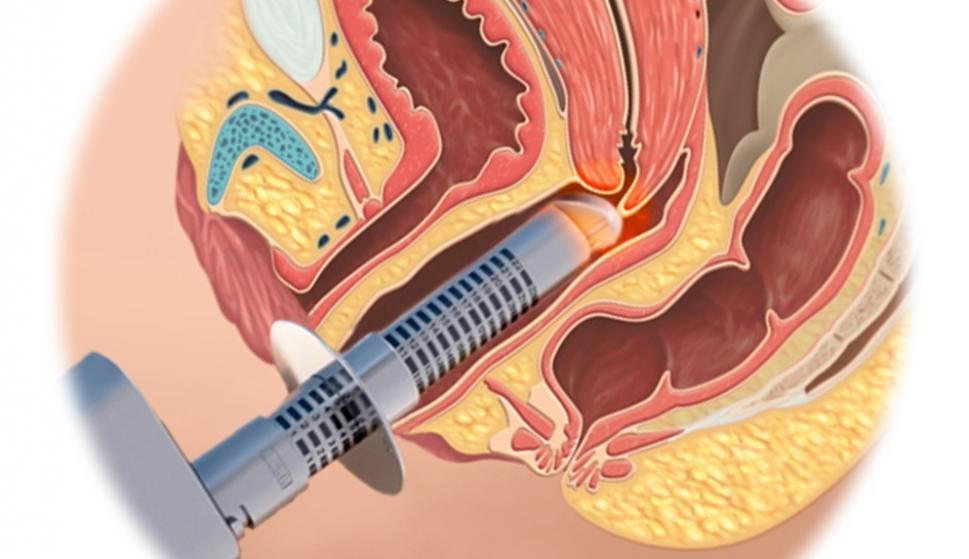 procedimento de rejuvenescimento vaginal com laser