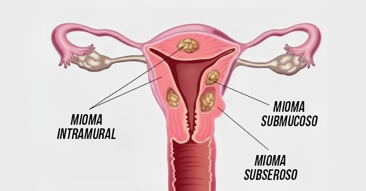 Tratamento para mioma uterino: guia completo de medicamentos, cirurgias e tecnologias 2 Tratamento para mioma uterino: guia completo de medicamentos, cirurgias e tecnologias