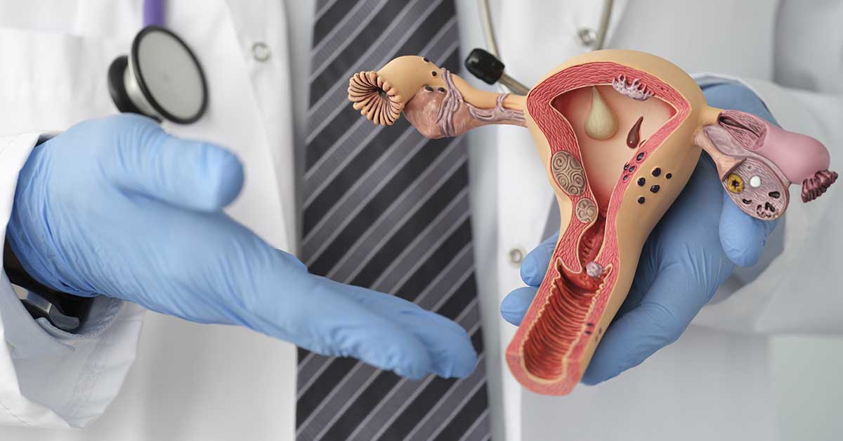 Tratamento para mioma uterino: guia completo de medicamentos, cirurgias e tecnologias 3 Tratamento para mioma uterino: guia completo de medicamentos, cirurgias e tecnologias