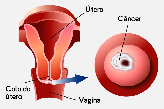 câncer de útero