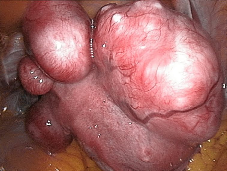 mioma uterino