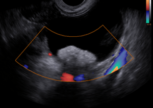 Teratoma de ovário ultrassom
