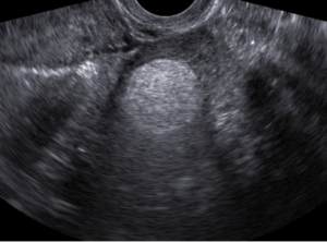 Teratoma no ovário ultrassom