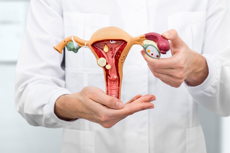 pólipo endometrial
