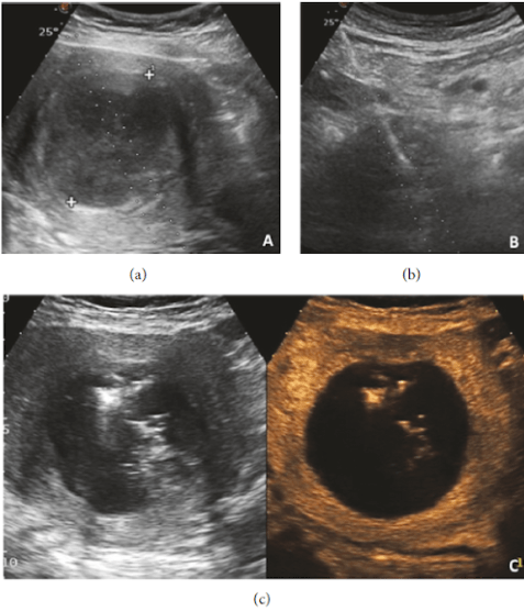 Miomas Uterinos: ultrassom