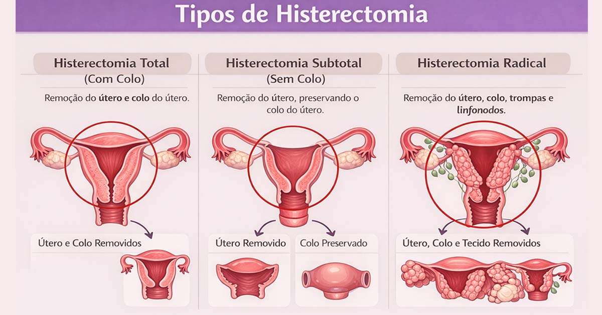 Tipos de Histerectomia Imagem tipos de Histerectomia
