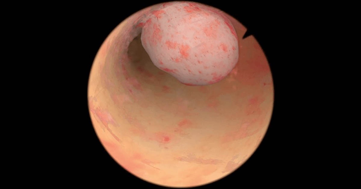 Pólipo endometrial: sintomas, riscos de câncer e tratamento por histeroscopia 2 Pólipo endometrial: sintomas, riscos de câncer e tratamento por histeroscopia