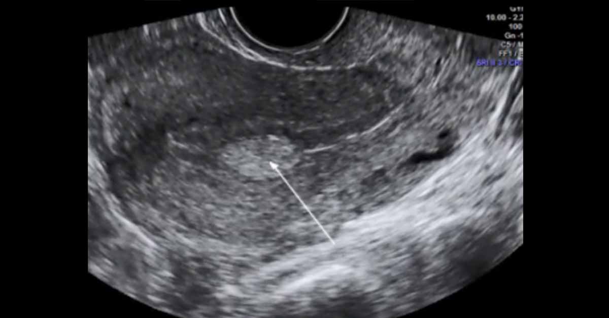 Pólipo endometrial: sintomas, riscos de câncer e tratamento por histeroscopia 3 Pólipo endometrial: sintomas, riscos de câncer e tratamento por histeroscopia