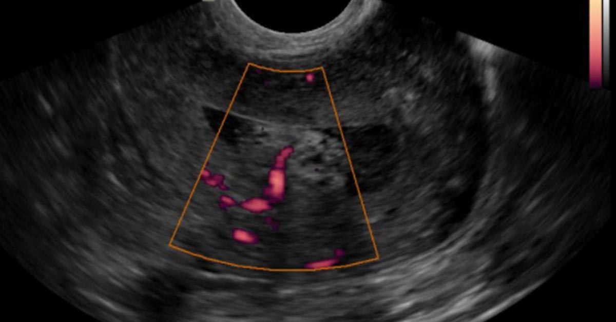 Pólipo endometrial: sintomas, riscos de câncer e tratamento por histeroscopia 4 Pólipo endometrial: sintomas, riscos de câncer e tratamento por histeroscopia