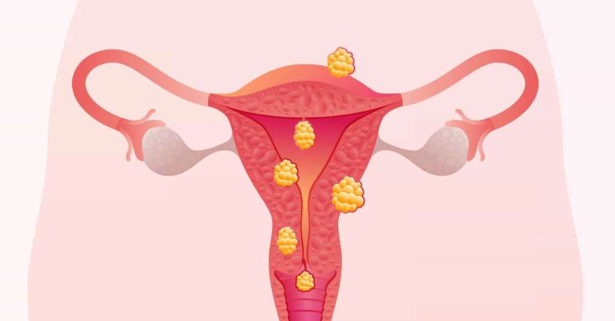 Decidindo pela Miomectomia: quando a cirurgia é a melhor opção? 3 -Decidindo-pela-Miomectomia_-Quando-a-Cirurgia-e-a-Melhor-Opcao