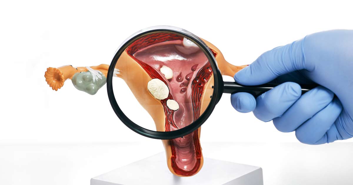 Decidindo pela Miomectomia: quando a cirurgia é a melhor opção? 2 Decidindo-pela-Miomectomia_-Quando-a-Cirurgia-e-a-Melhor-Opcao