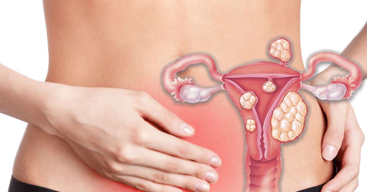 Decidindo pela Miomectomia: quando a cirurgia é a melhor opção? 1 Decidindo-pela-Miomectomia_-Quando-a-Cirurgia-e-a-Melhor-Opcao.
